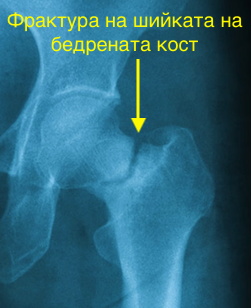 Остеопороза