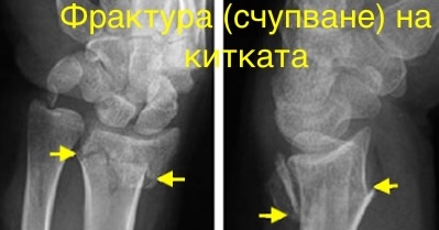 Остеопороза
