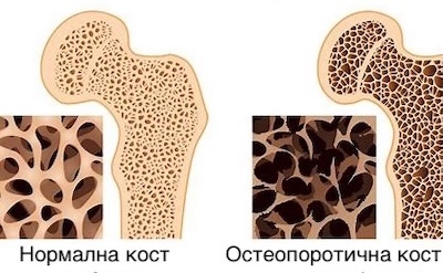 Ревматоиден артрит